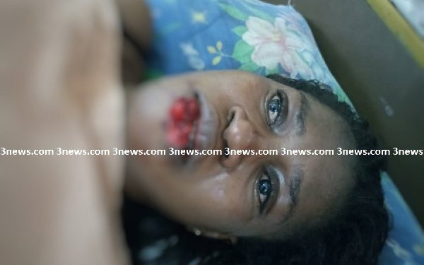 Jealous girlfriend chews lip of suspected rival in Takoradi