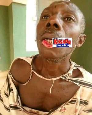 Man’s lip chewed over 1 cedi tot of Akpeteshi