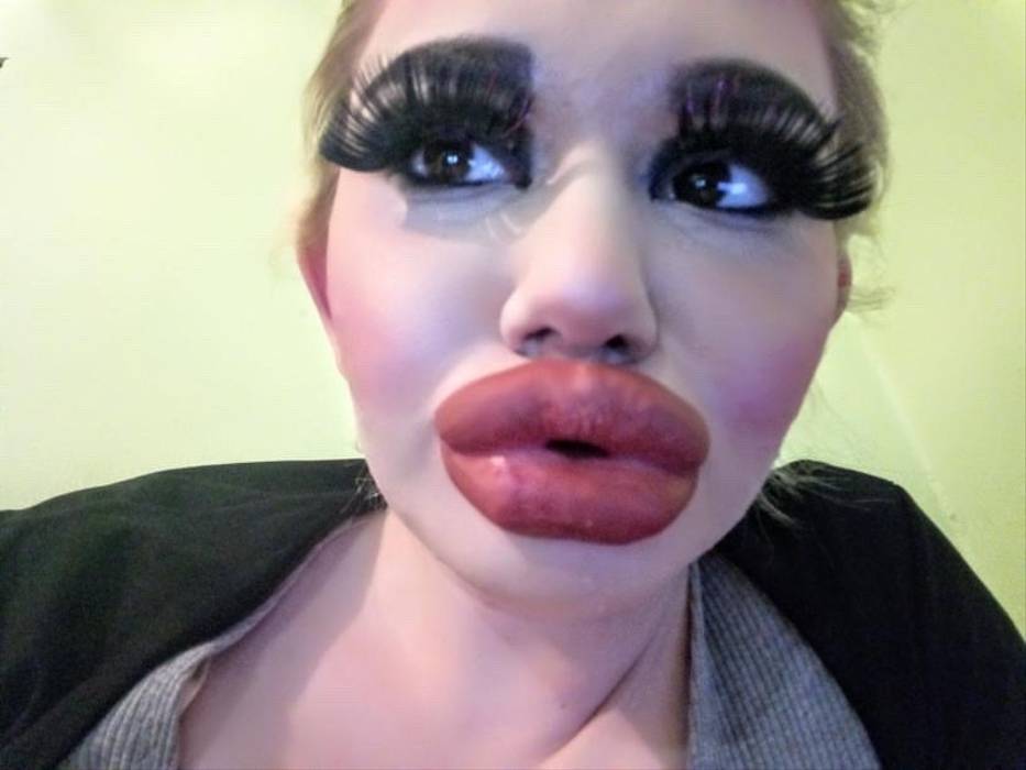 Bulgarian woman addicted to lip fillers quadruples size of her natural ...