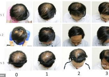 Scientists claim to have found a cure for baldness