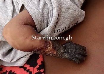 Baby’s hand rots after medical negligence but hospital blames ‘juju’