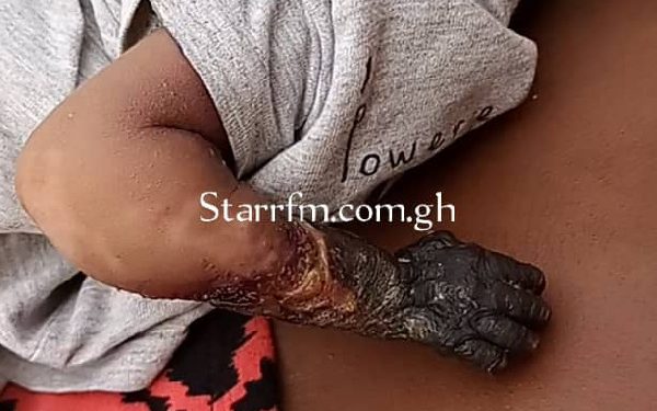 Baby’s hand rots after medical negligence but hospital blames ‘juju’