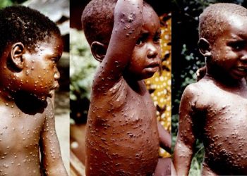 WHO confirms 80 cases of monkeypox with outbreaks in 11 countries