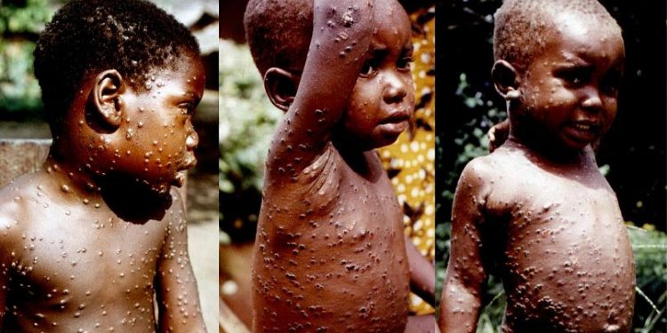 WHO confirms 80 cases of monkeypox with outbreaks in 11 countries