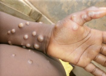 5 cases of monkeypox confirmed in Ghana