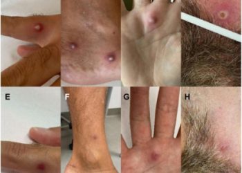 Man diagnosed with monkeypox, HIV, and Covid-19