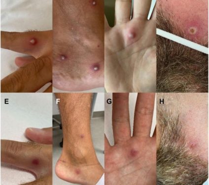 Man diagnosed with monkeypox, HIV, and Covid-19