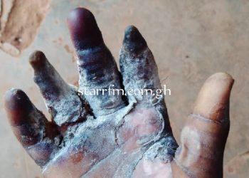 17-year-old boy losing fingers after ‘Pastor’ scalds palm over missing GH¢600