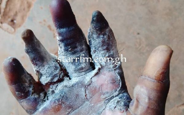 17-year-old boy losing fingers after ‘Pastor’ scalds palm over missing GH¢600