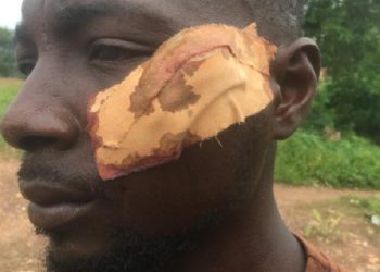Machete fight between youth over woman at Twifo Abodom leaves 7 injured