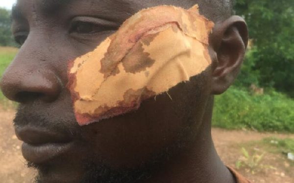 Machete fight between youth over woman at Twifo Abodom leaves 7 injured