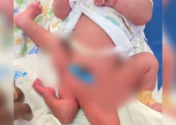 KATH surgeons perform complex limb malformation operation