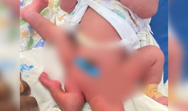 KATH surgeons perform complex limb malformation operation