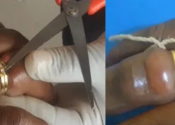 Woman nearly lost finger after wearing wedding ring she bought from her friend