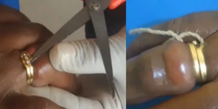 Woman nearly lost finger after wearing wedding ring she bought from her friend