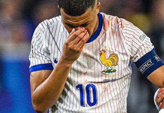 Mbappe ‘not doing well’ after nose injury