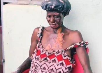 14-year-old girl burns her mother with hot water