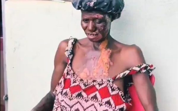 14-year-old girl burns her mother with hot water