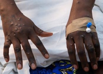 Ghana records two new Mpox cases, total now 119 – GHS