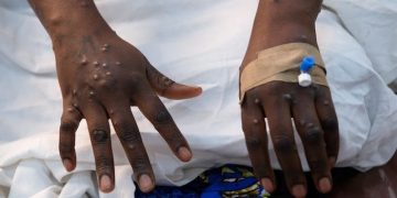 Ghana records two new Mpox cases, total now 119 – GHS