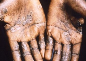 First Mpox death recorded in Ghana; 23 new cases confirmed