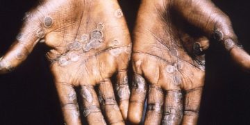 First Mpox death recorded in Ghana; 23 new cases confirmed